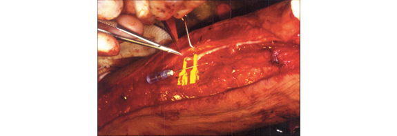 Micro Series  Micro Cutting & Taper Needled Suture